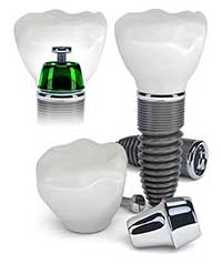 Dental Implants in Marine Park