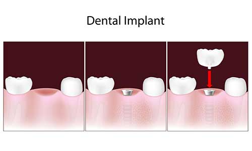 Marine Park Implant Dentist