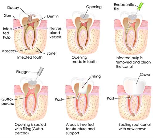 Marine Park Root Canal