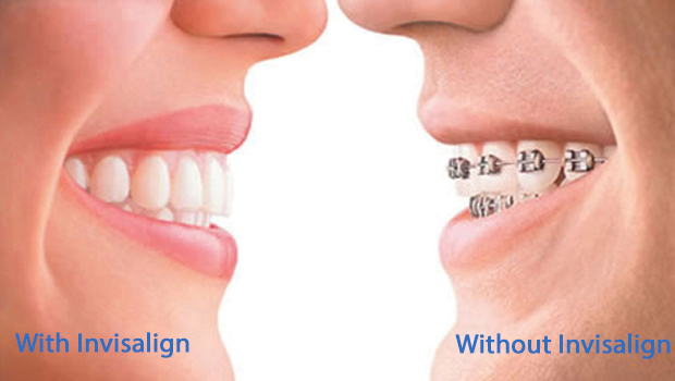 Invisalign in Marine Park