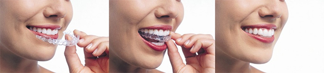 Marine Park Invisalign